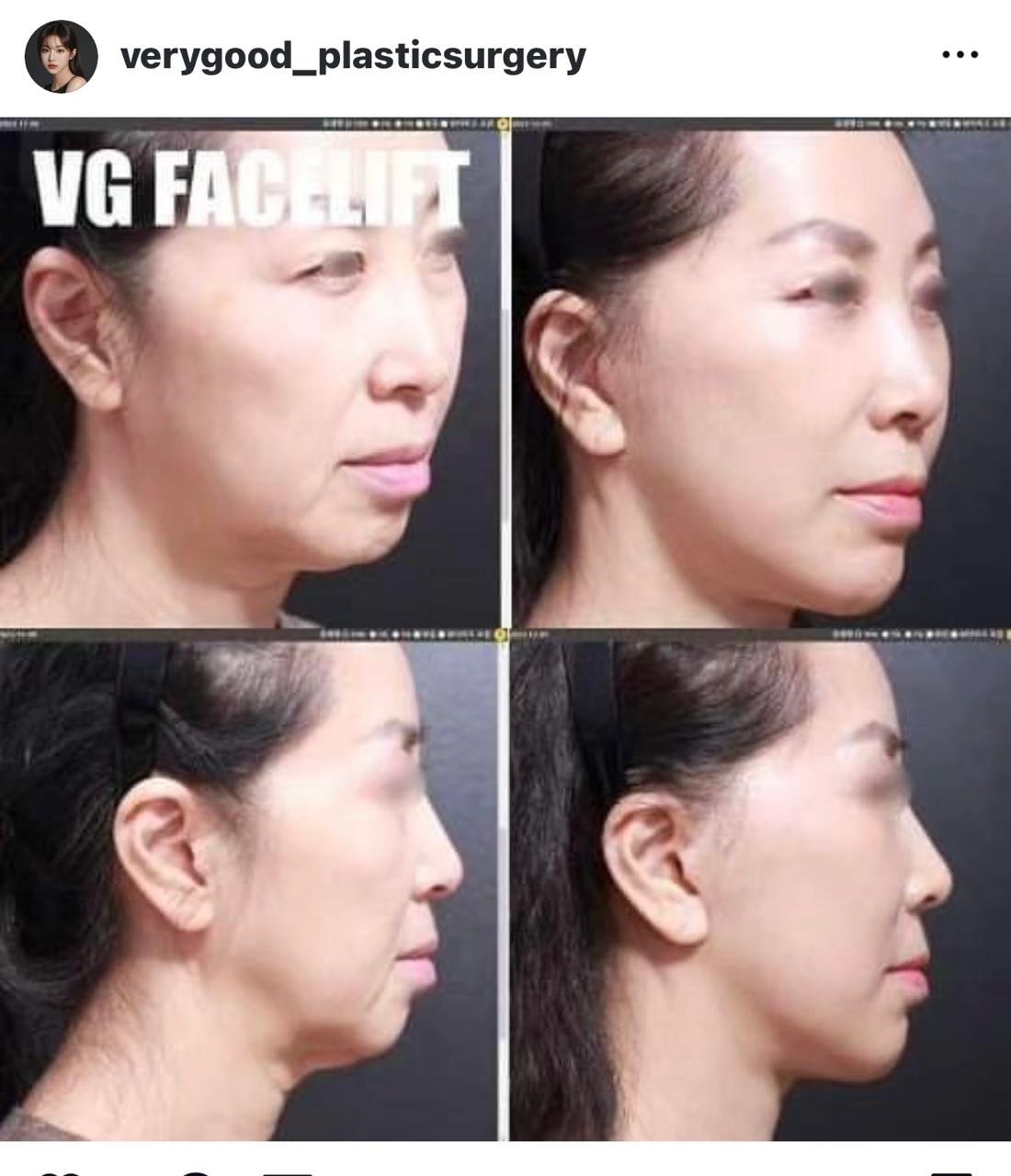 Before and after result by Dr. Kim Yong Woo
