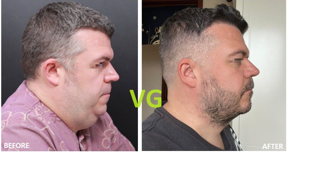 Before and after result by Dr. Kim Yong Woo