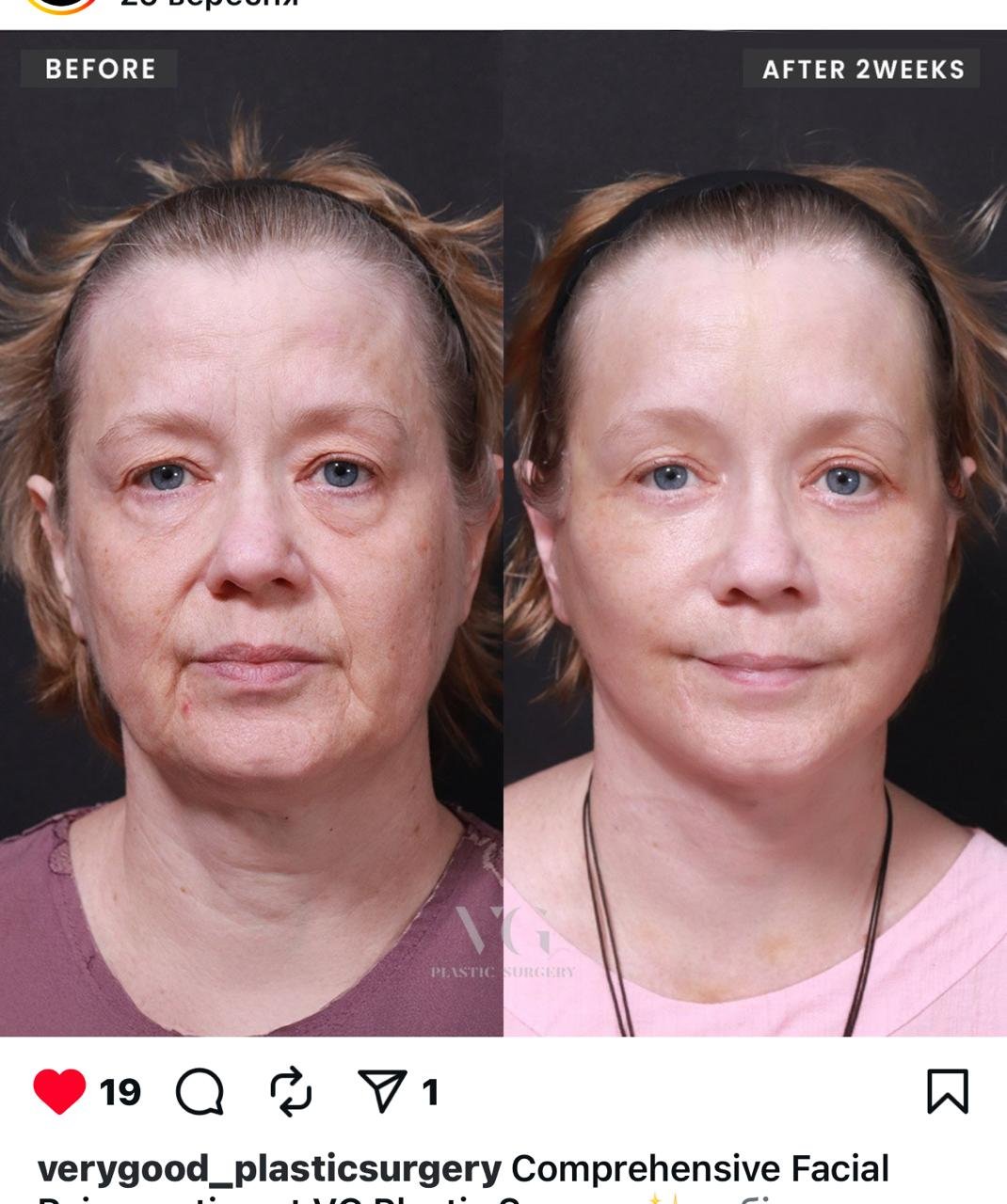 Before and after result by Dr. Im Young Min