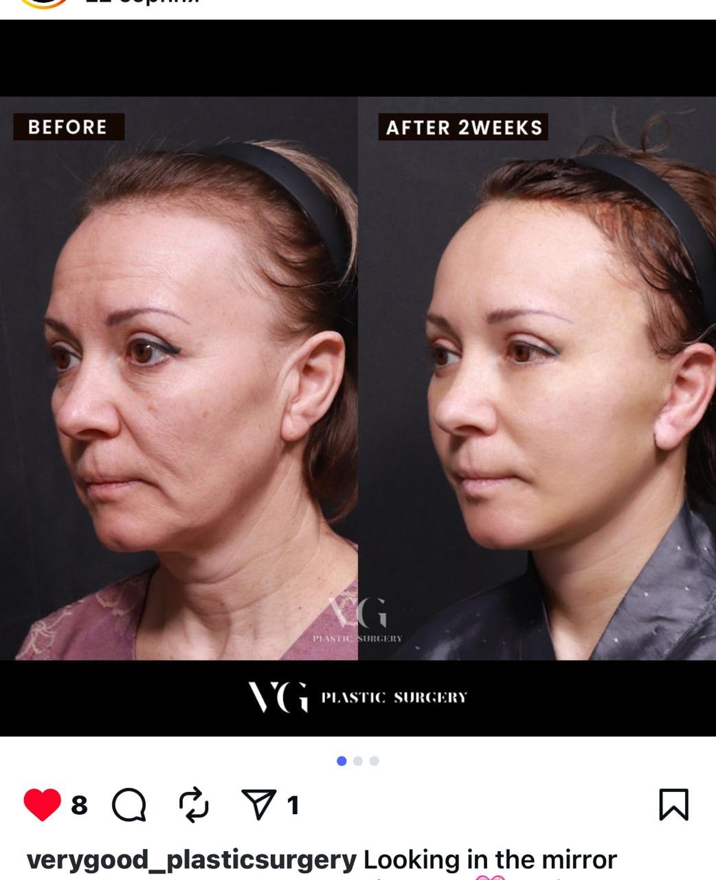 Before and after result by Dr. Kim Yong Woo