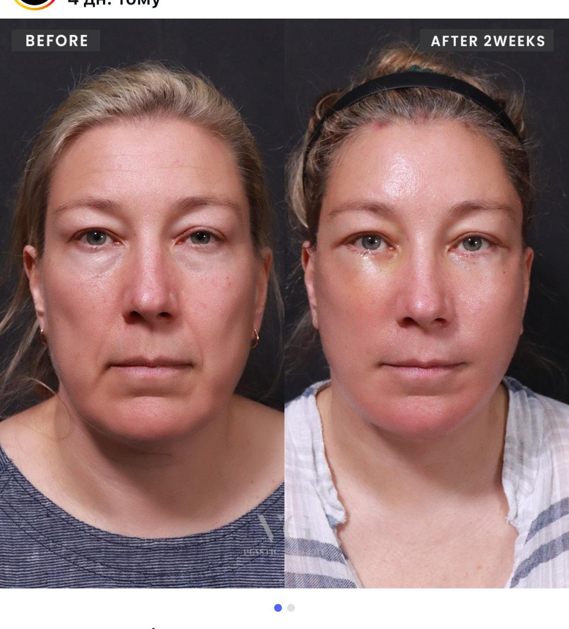 Before and after result by Dr. Im Young Min