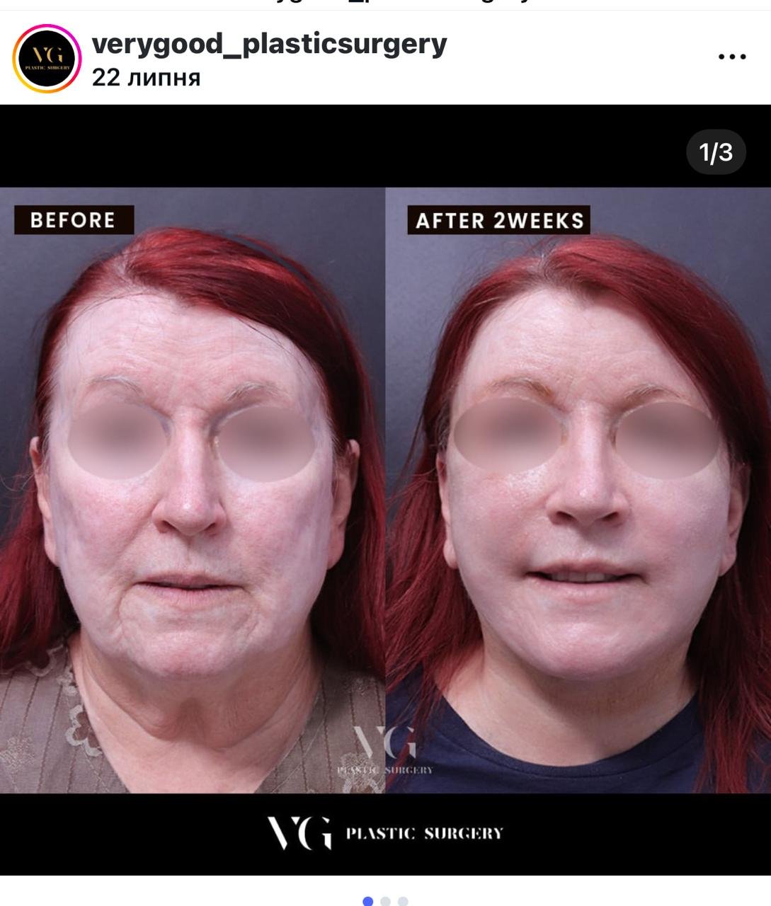 Before and after result by Dr. Kim Yong Woo