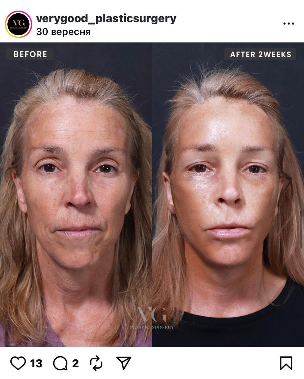 Before and after result by Dr. Im Young Min