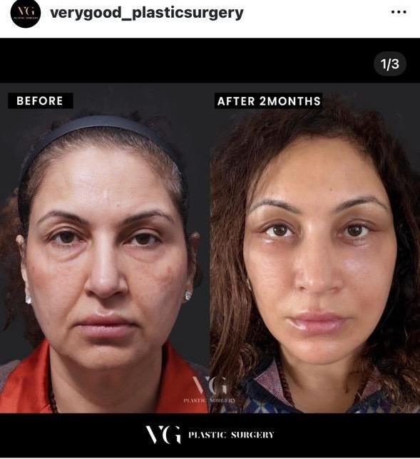 Before and after result by Dr. Kim Yong Woo