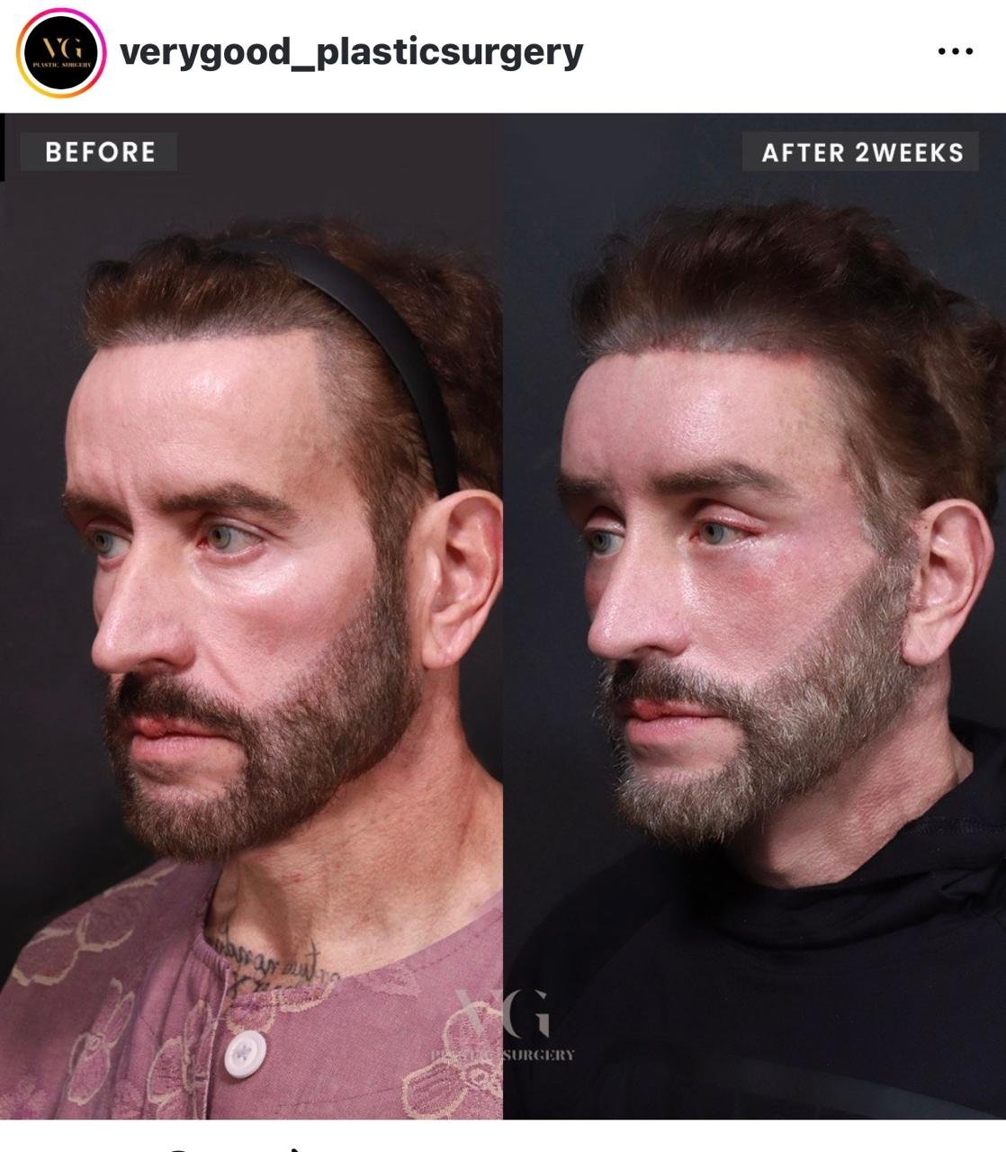 Before and after result by Dr. Im Young Min