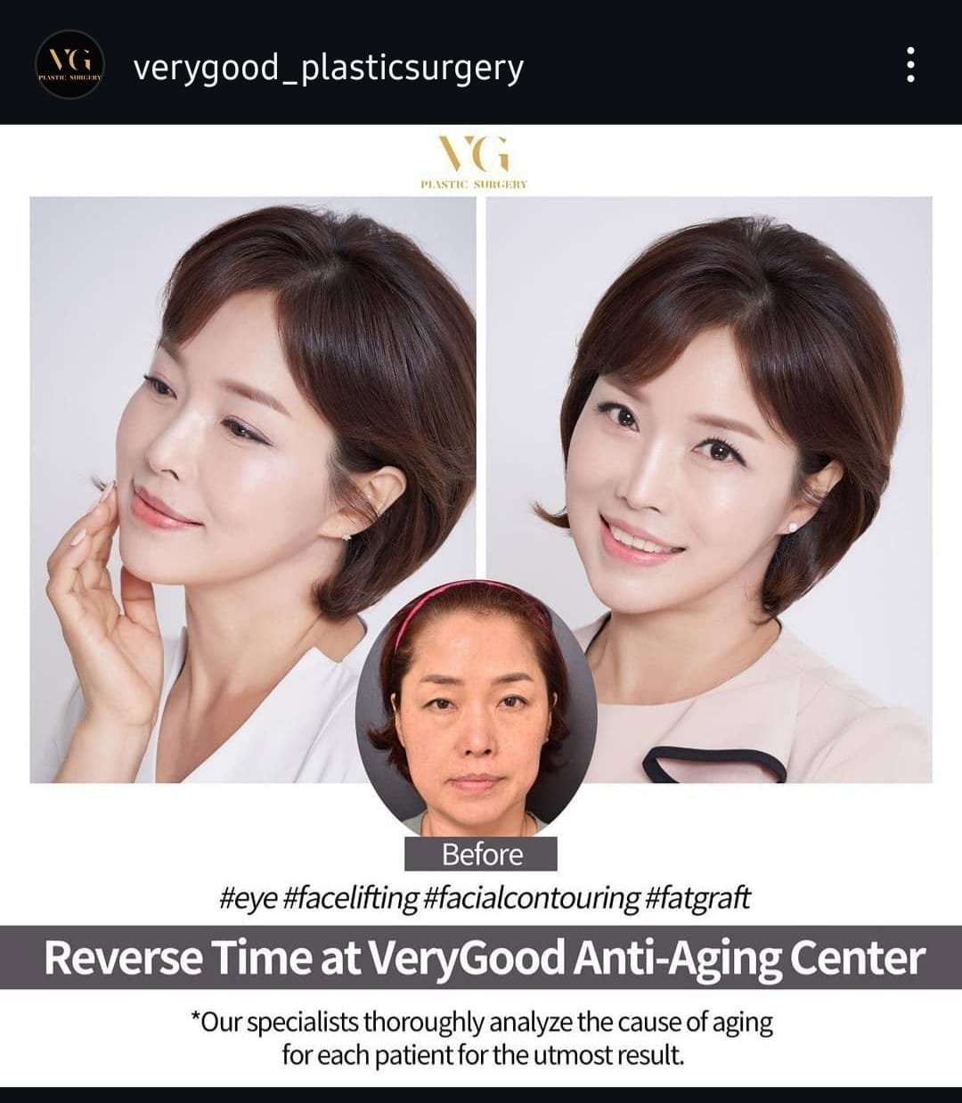 Before and after result by Dr. Kim Yong Woo