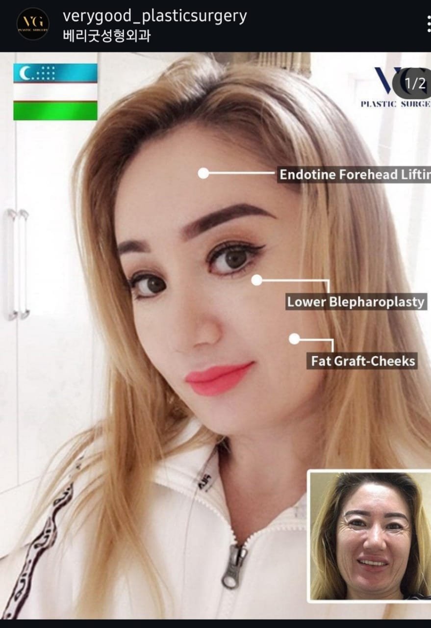 Before and after result by Dr. Im Young Min