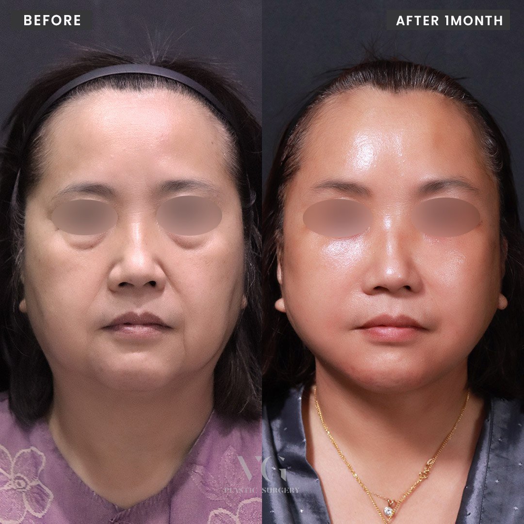 Before and after result by Dr. Im Young Min
