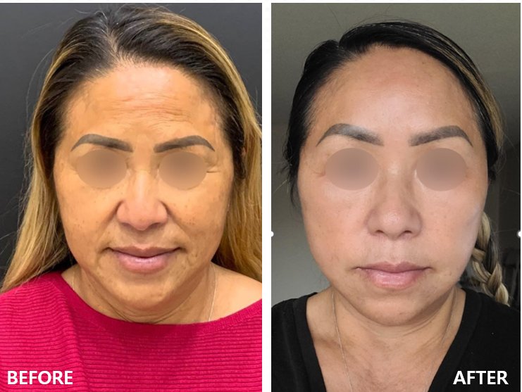Before and after result by Dr. Kim Yong Woo