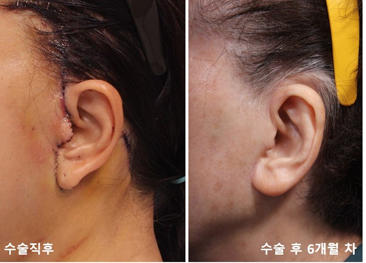 Before and after result by Dr. Im Young Min