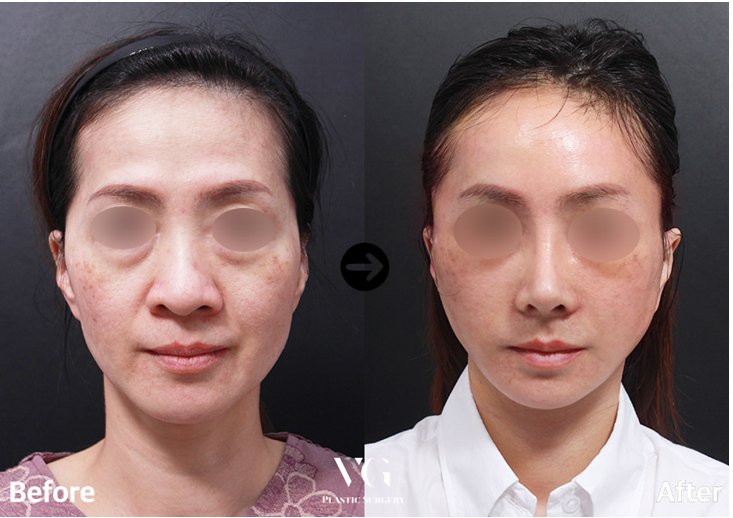 Before and after result by Dr. Kim Yong Woo