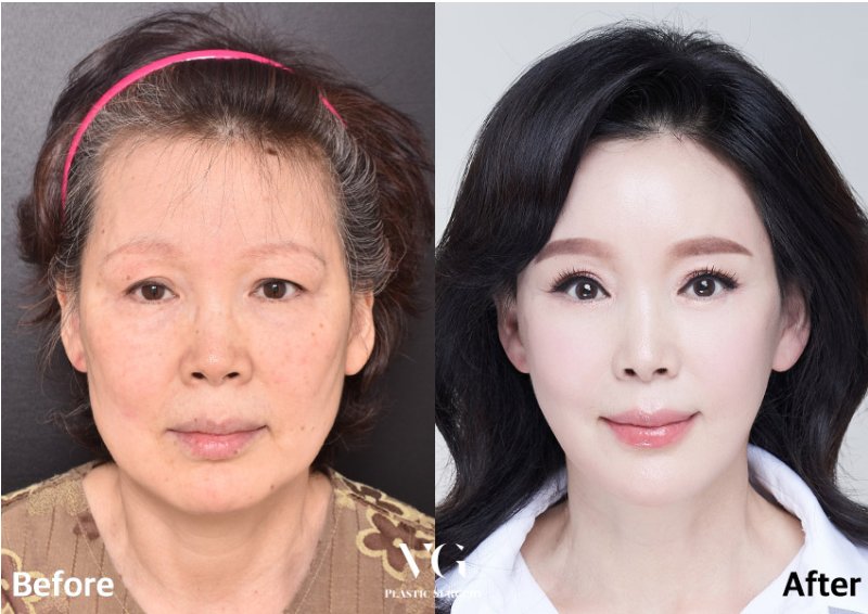 Before and after result by Dr. Kim Yong Woo