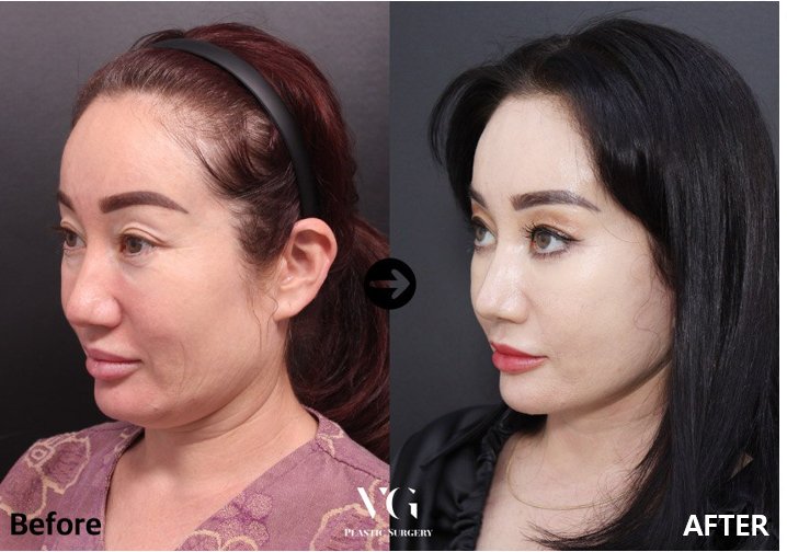Before and after result by Dr. Im Young Min