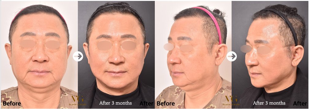 Before and after result by Dr. Kim Yong Woo