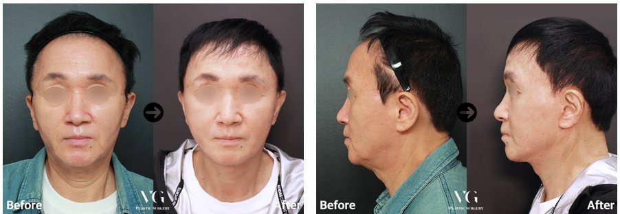 Before and after result by Dr. Im Young Min