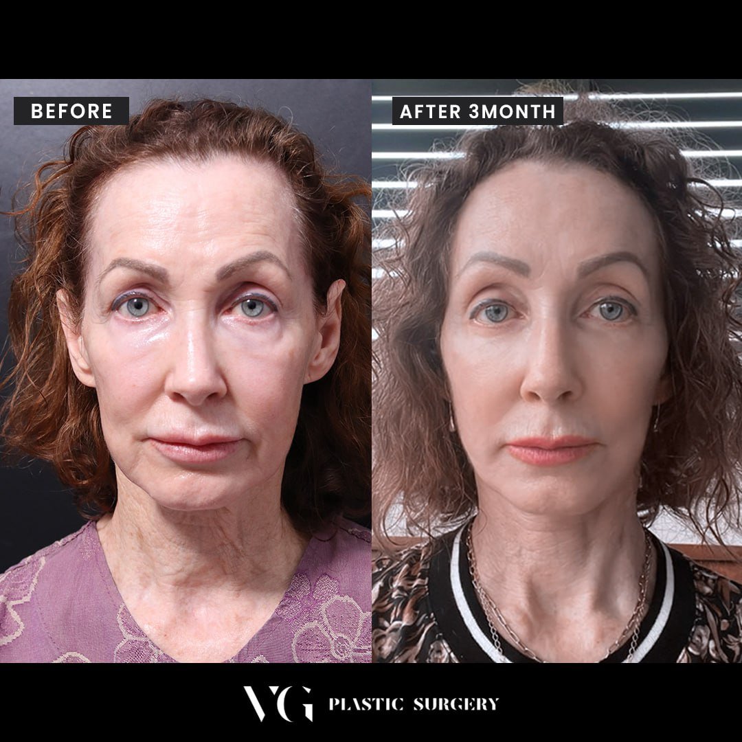 Before and after result by Dr. Kim Yong Woo