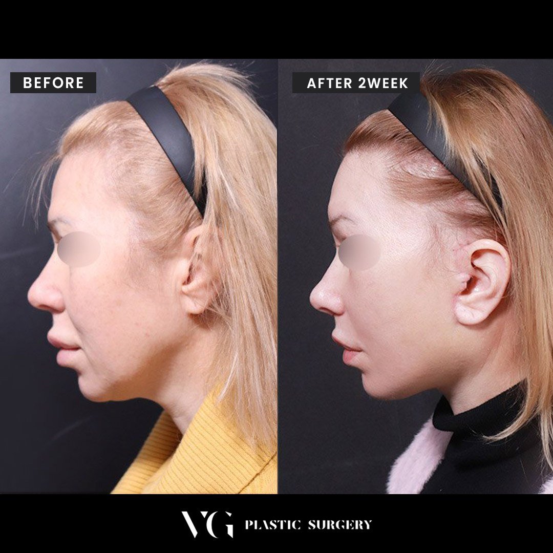 Before and after result by Dr. Im Young Min