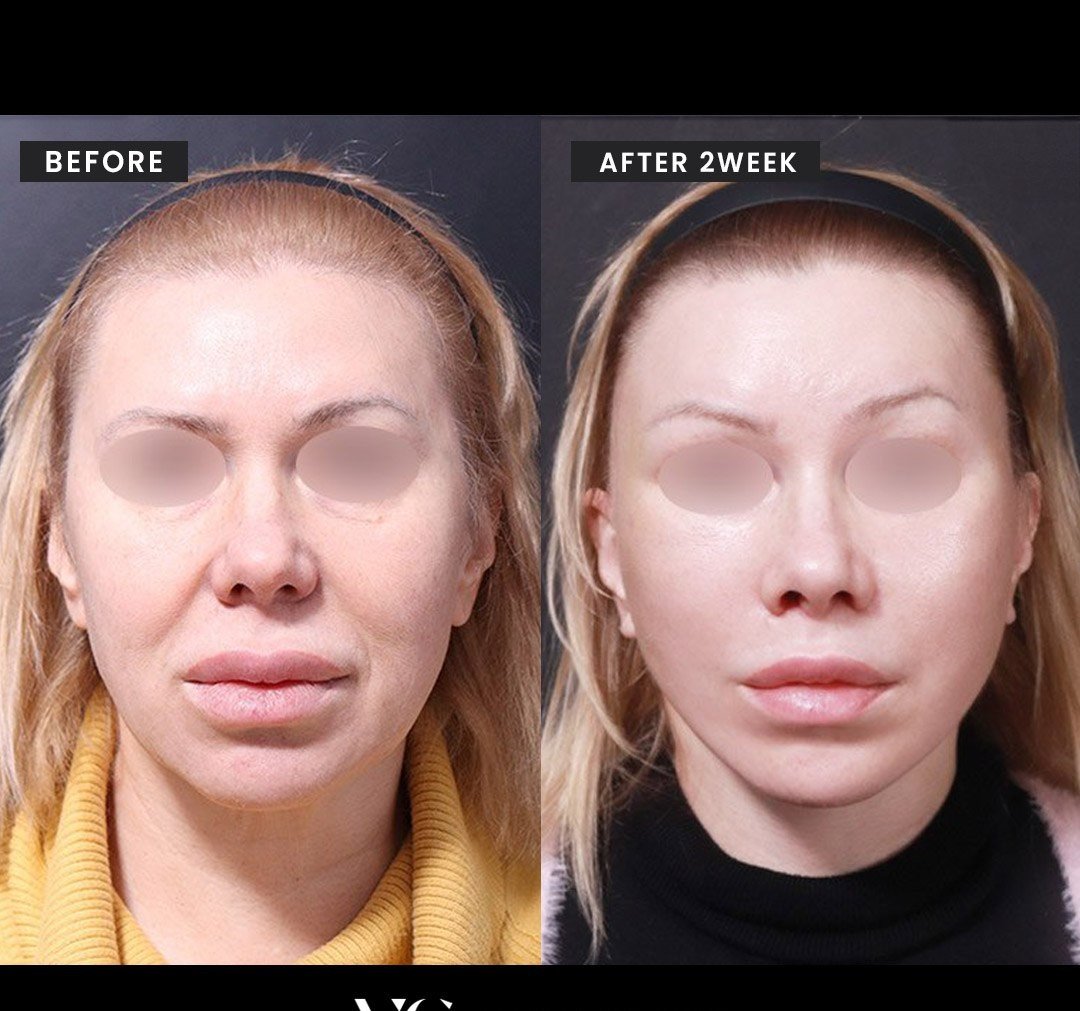 Before and after result by Dr. Kim Yong Woo