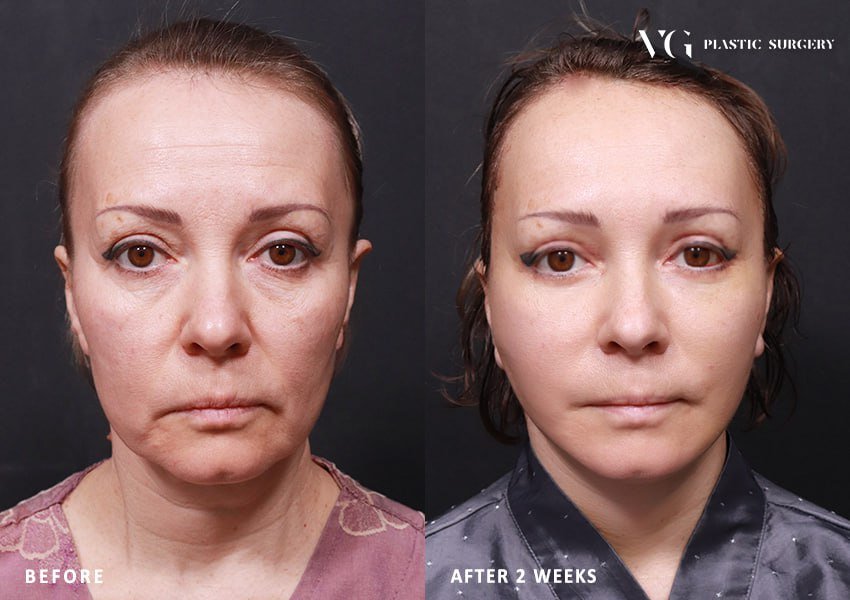 Before and after result by Dr. Kim Yong Woo