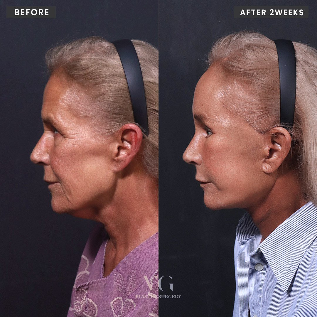 Before and after result by Dr. Im Young Min