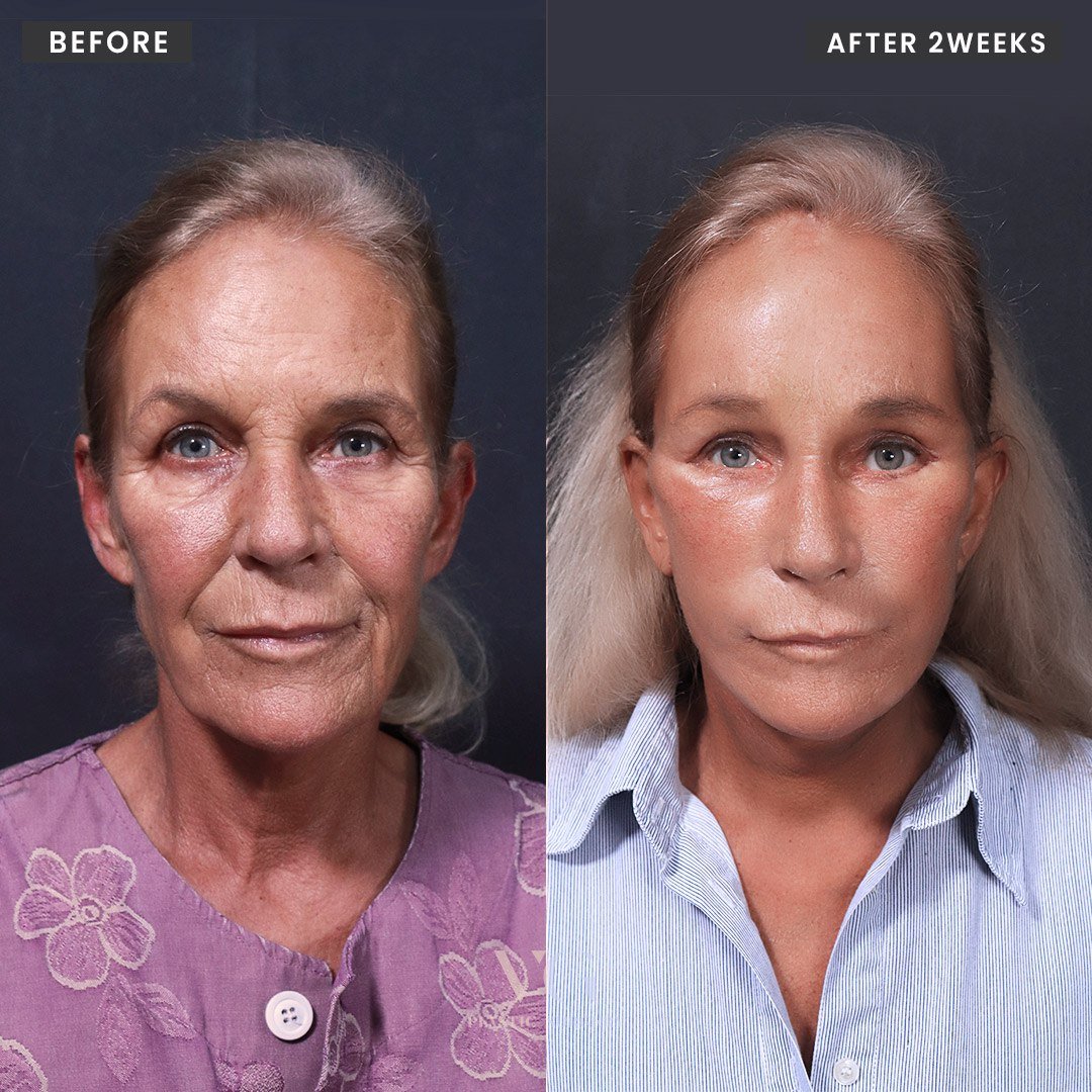 Before and after result by Dr. Kim Yong Woo