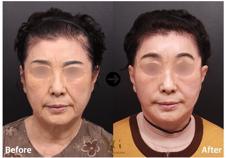 Before and after result by Dr. Kim Yong Woo