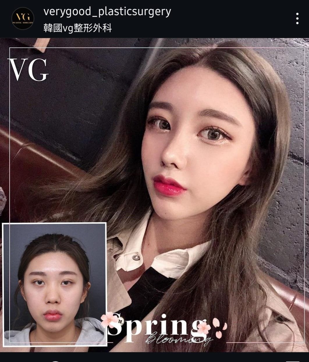 Before and after result by Dr. Im Young Min