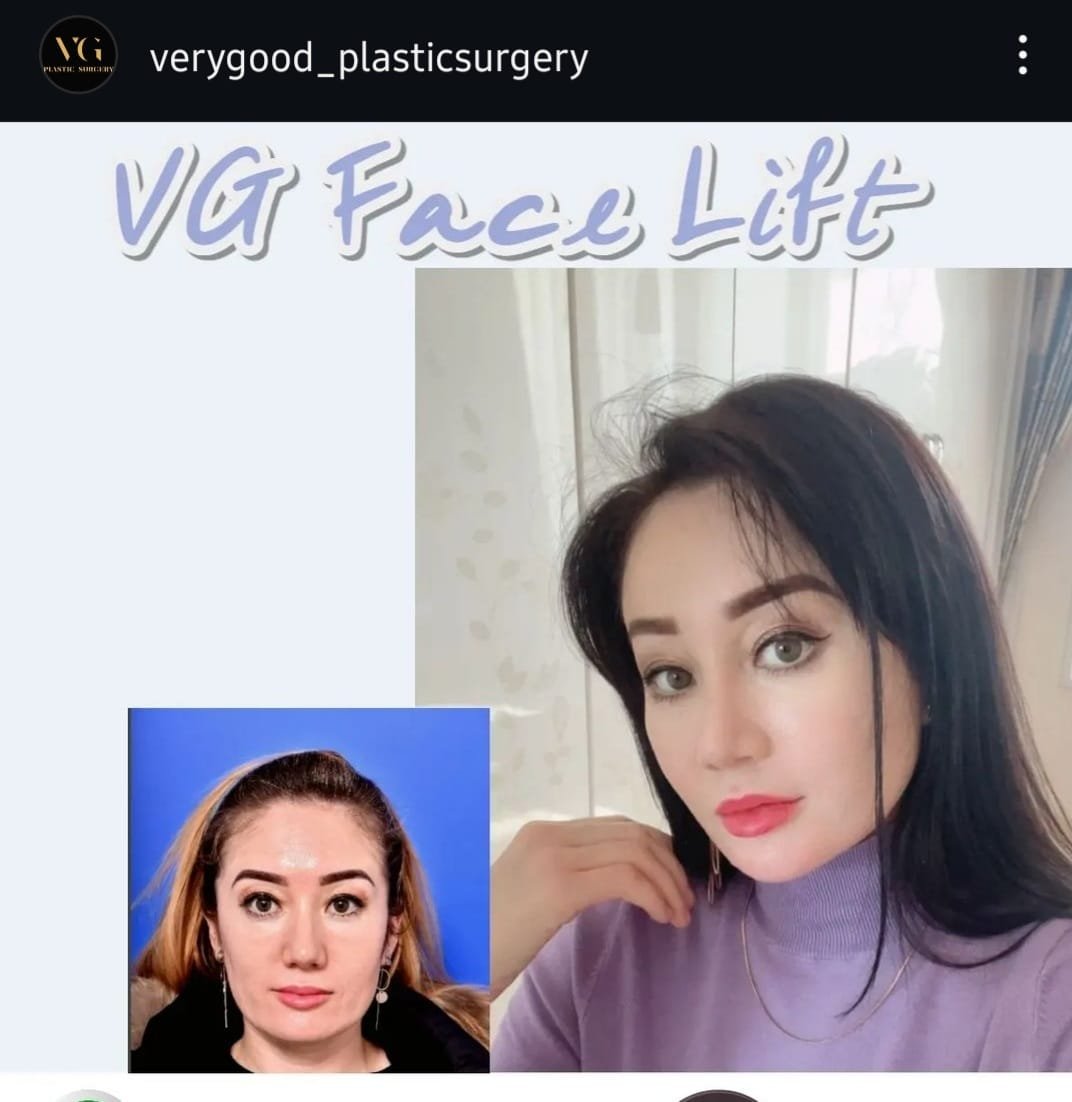 Before and after result by Dr. Im Young Min