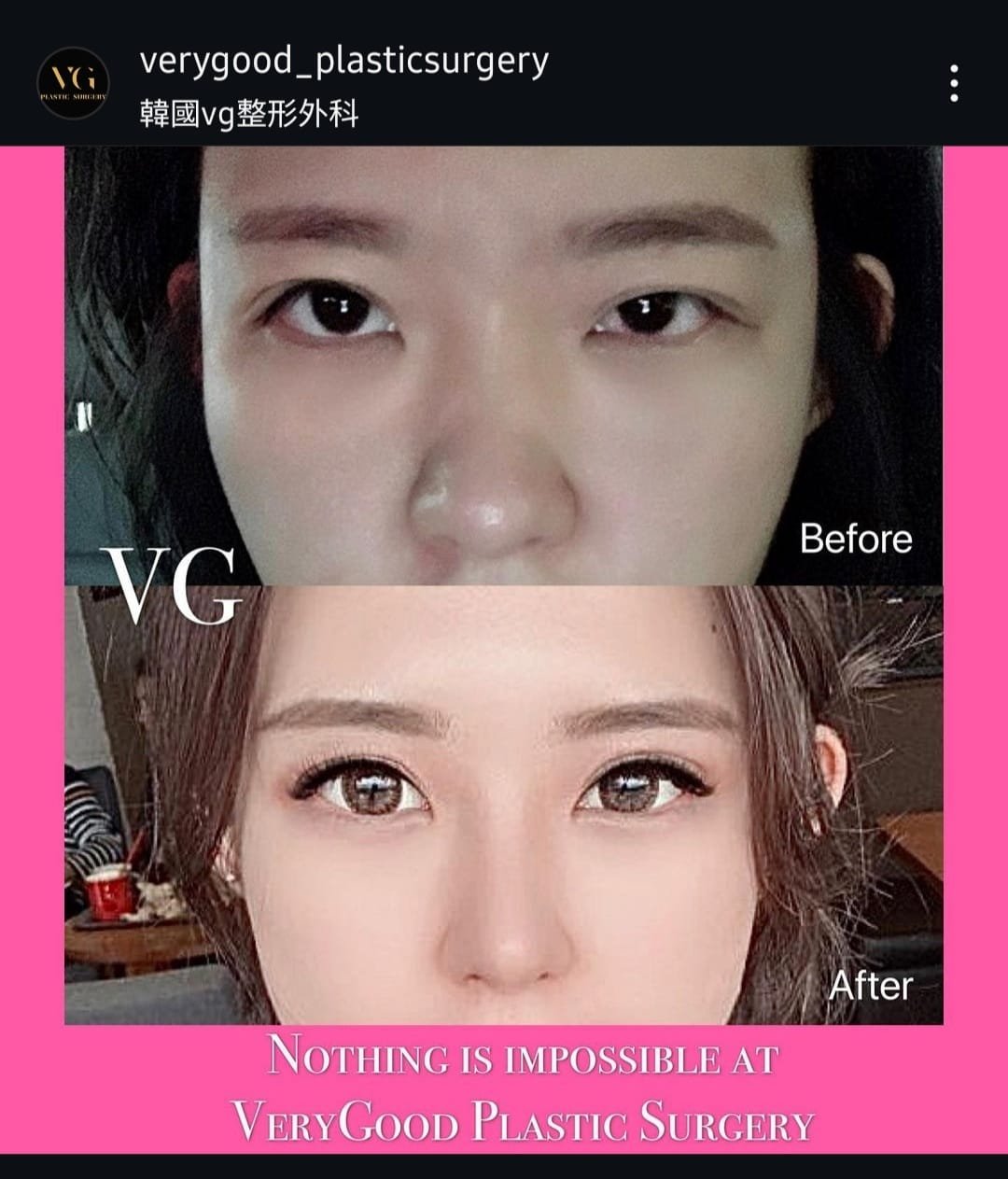Before and after result by Dr. Kim Yong Woo
