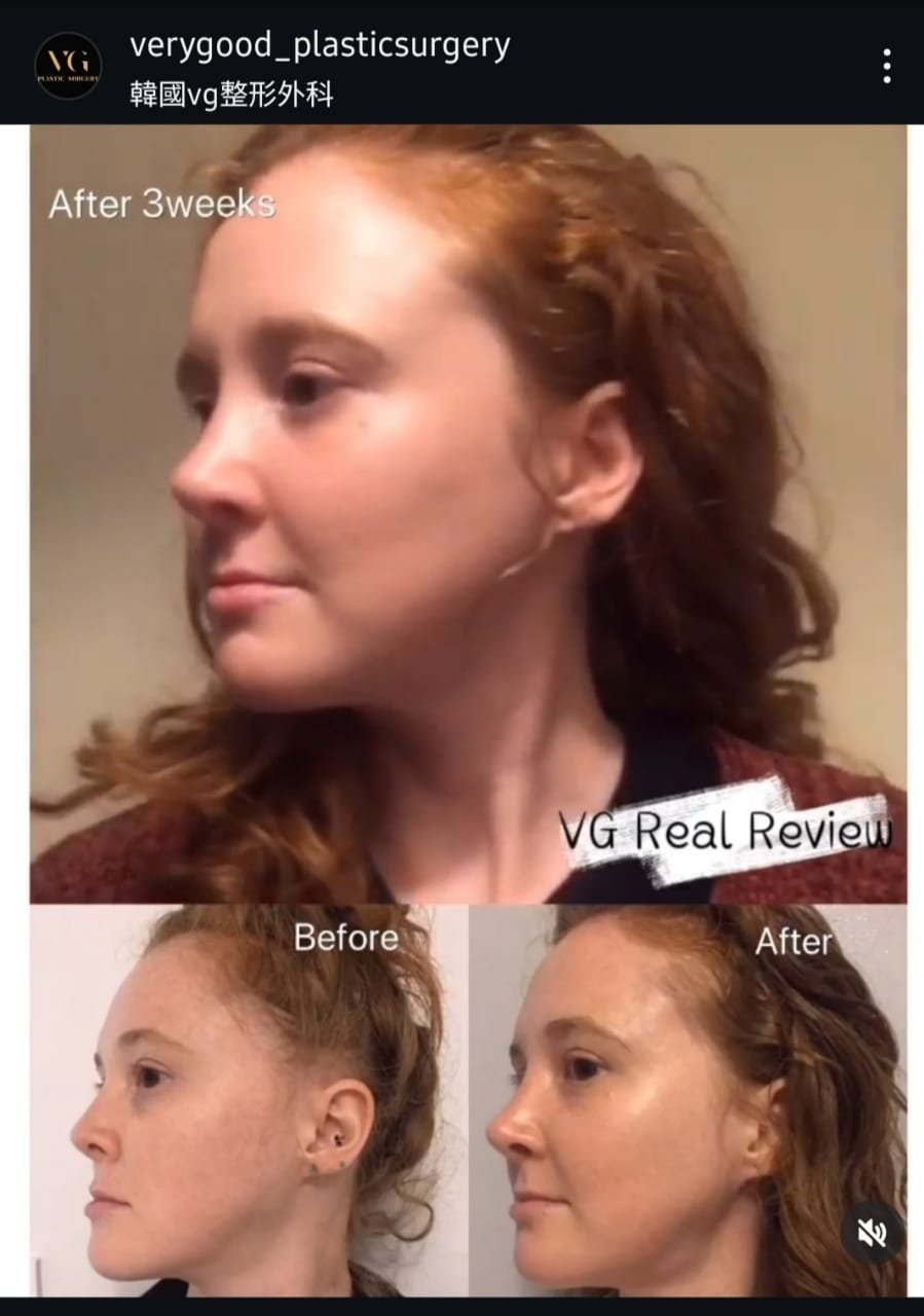 Before and after result by Dr. Kim Yong Woo