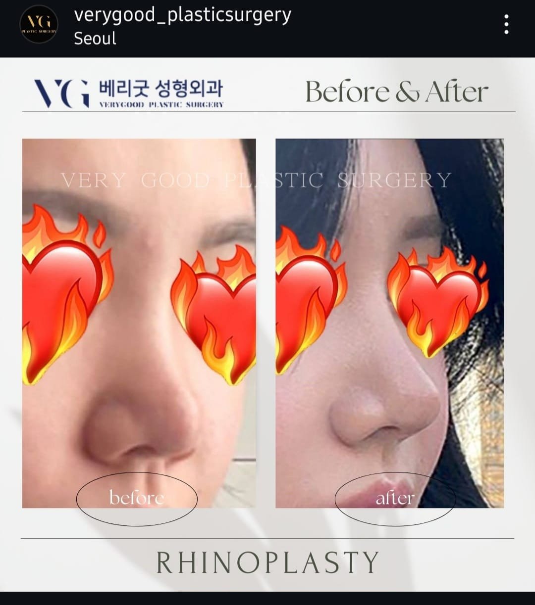Before and after result by Dr. Kim Yong Woo