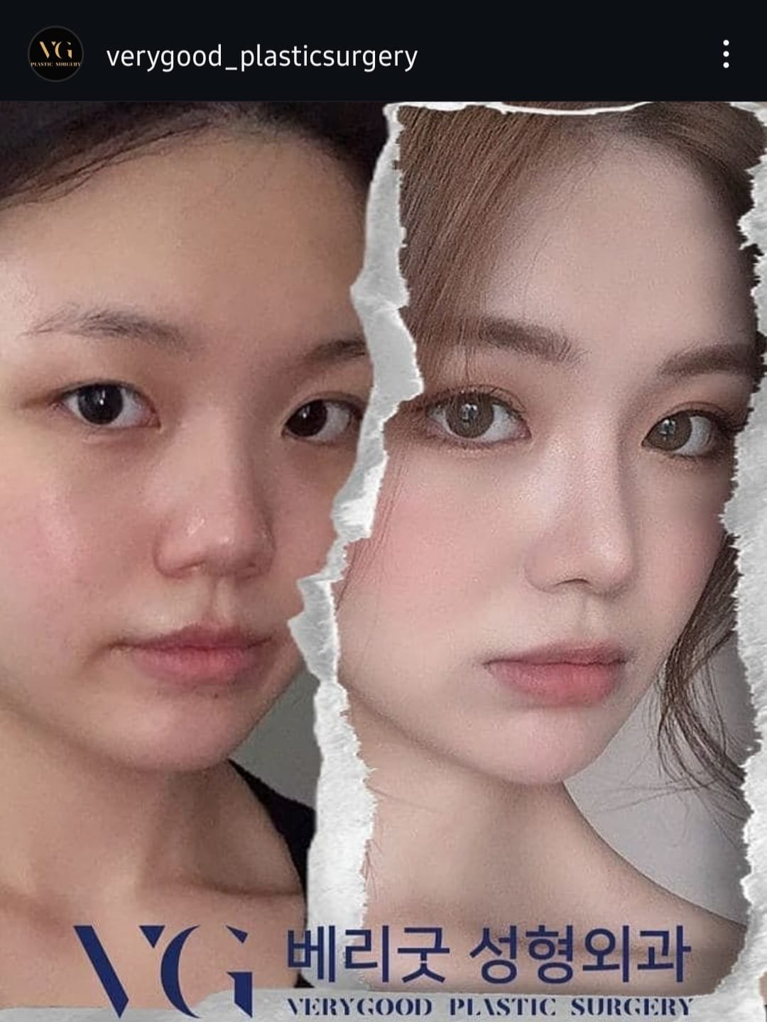 Before and after result by Dr. Kim Yong Woo