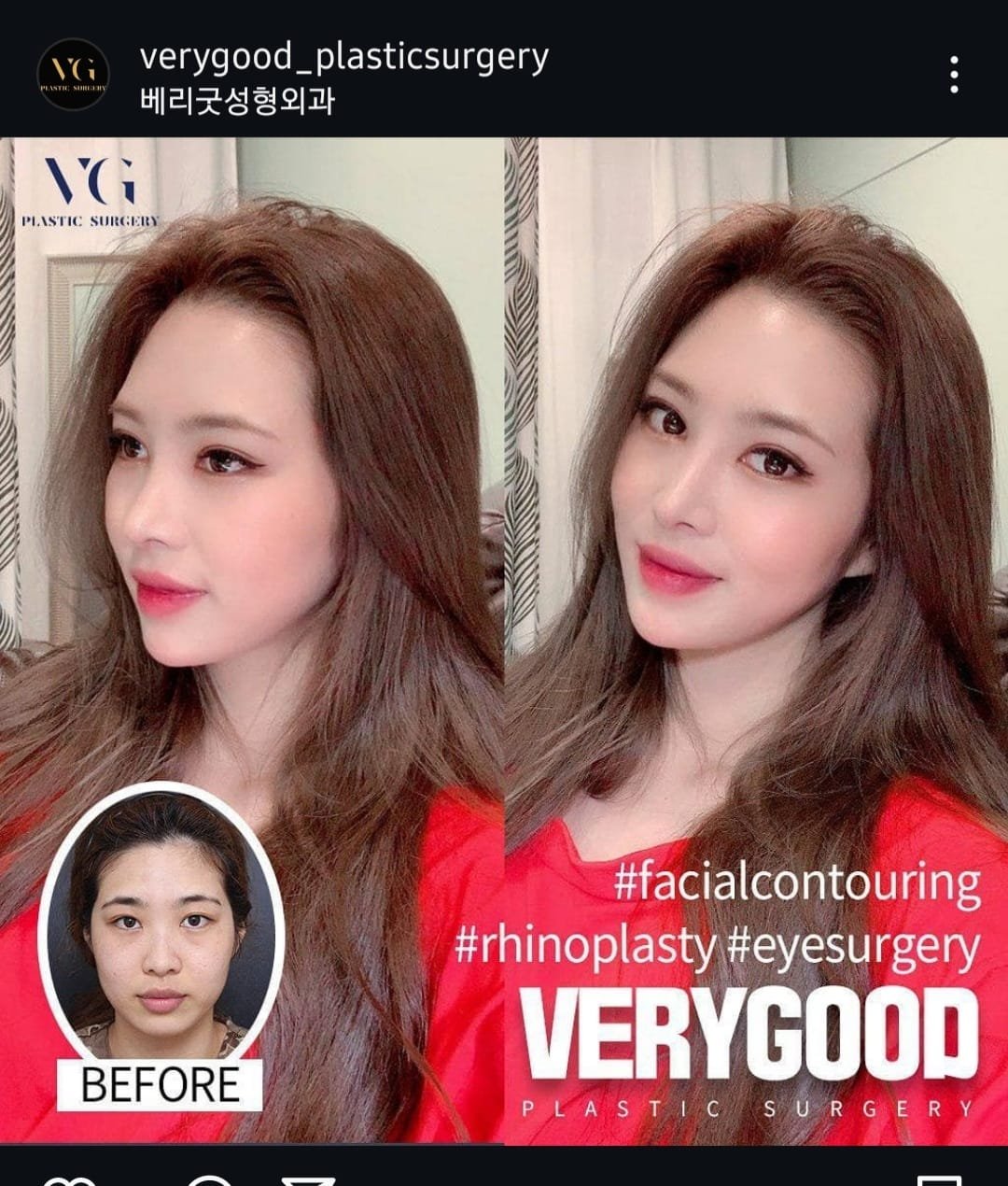 Before and after result by Dr. Im Young Min