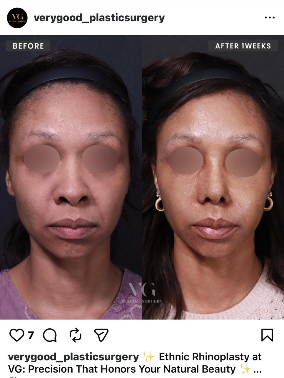 Before and after result by Dr. Im Young Min