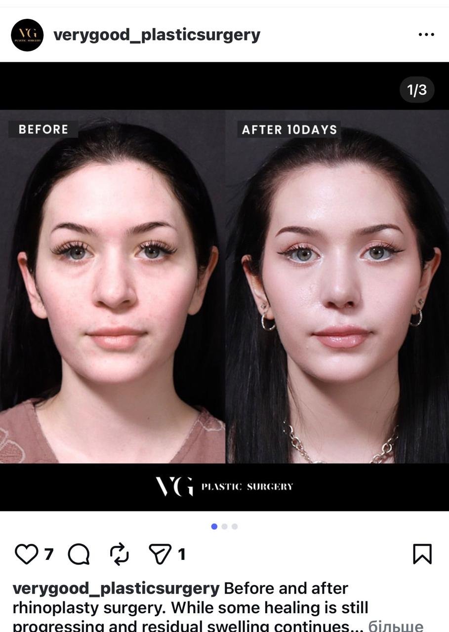 Before and after result by Dr. Kim Yong Woo