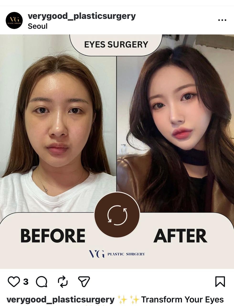 Before and after result by Dr. Im Young Min