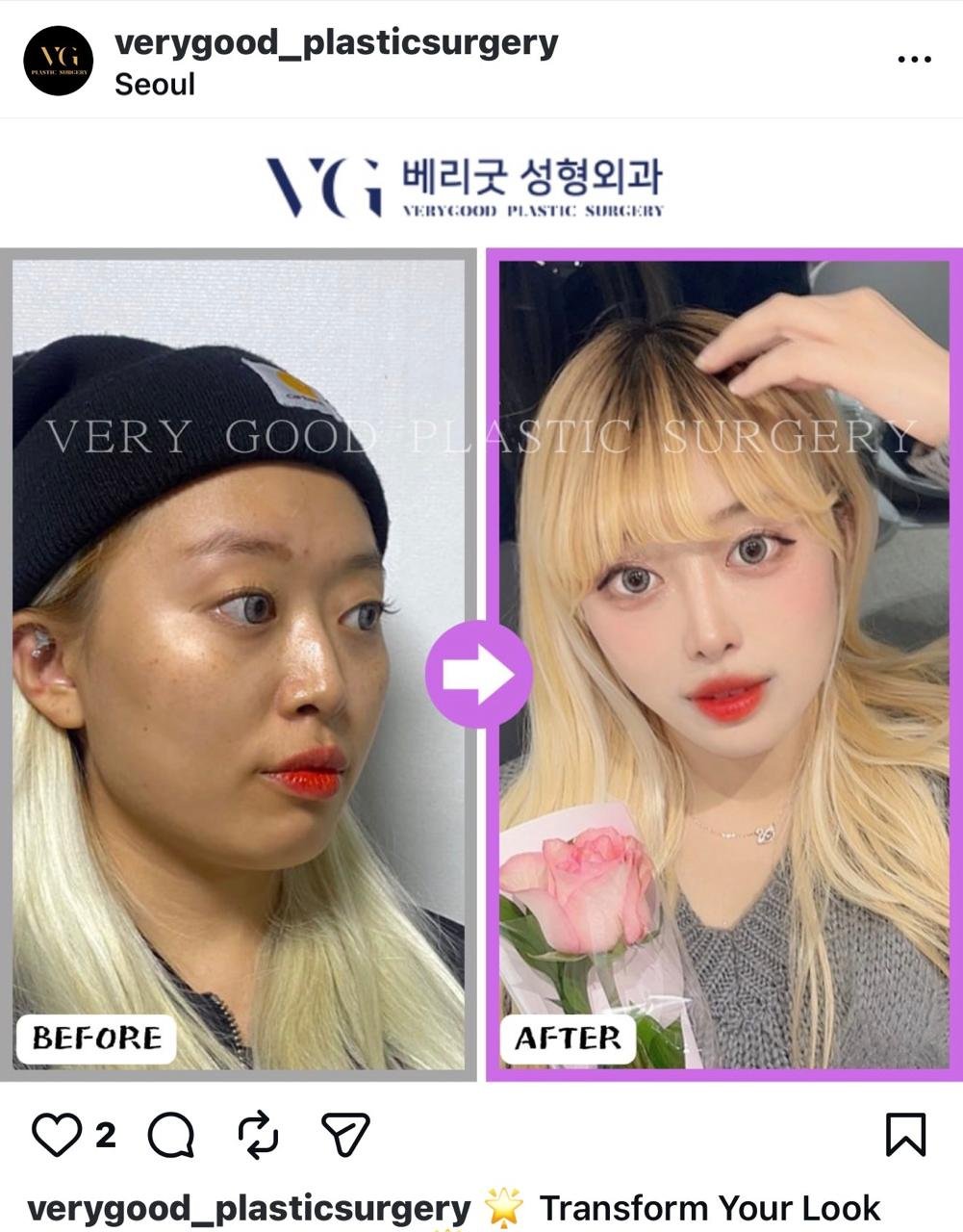 Before and after result by Dr. Kim Yong Woo