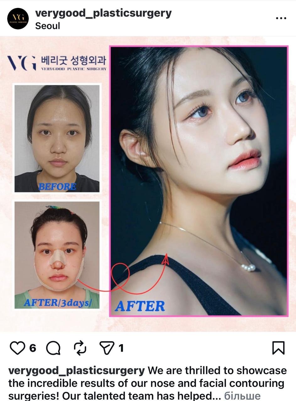 Before and after result by Dr. Kim Yong Woo