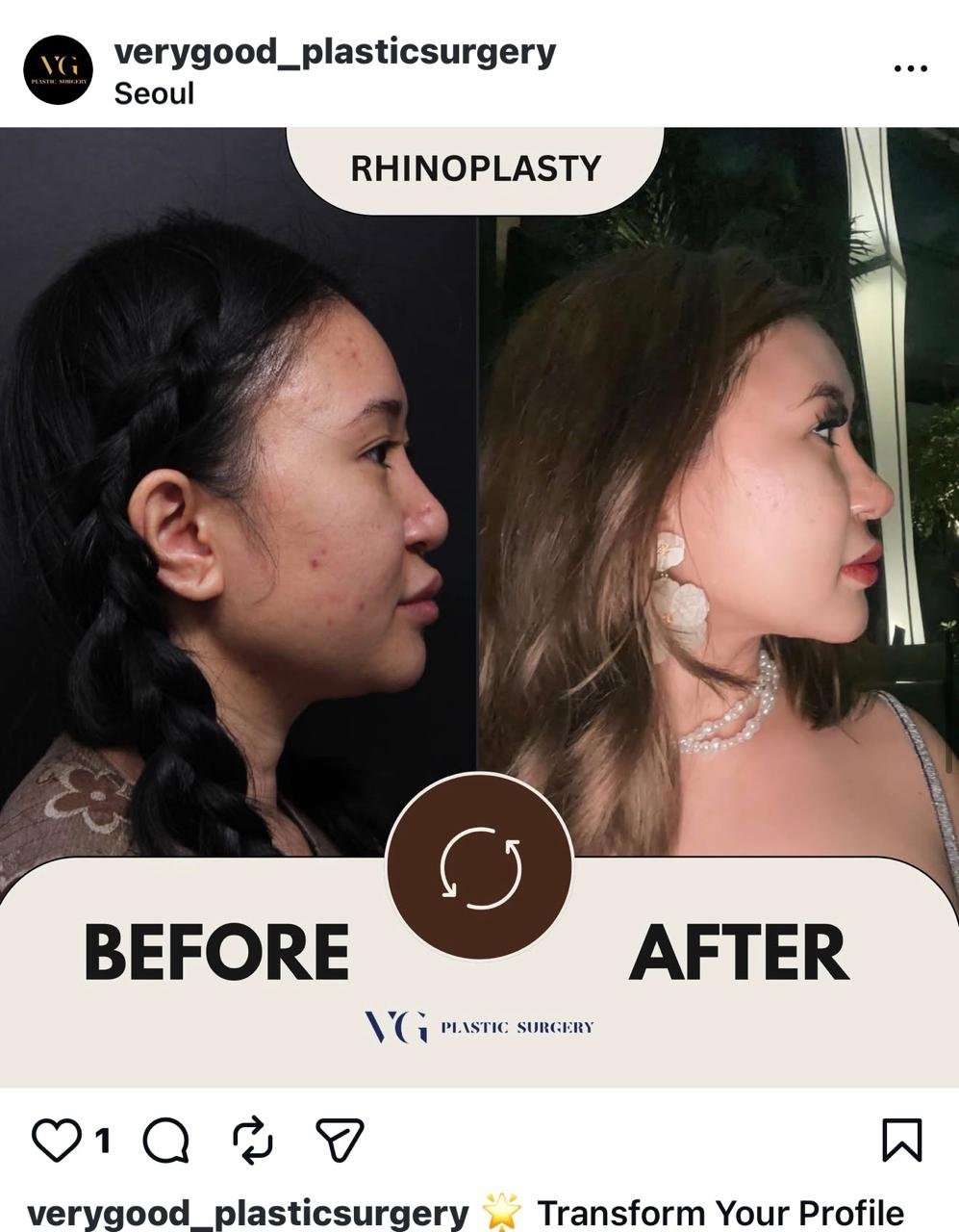 Before and after result by Dr. Im Young Min