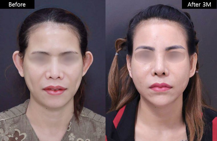 Before and after result by Dr. Im Young Min