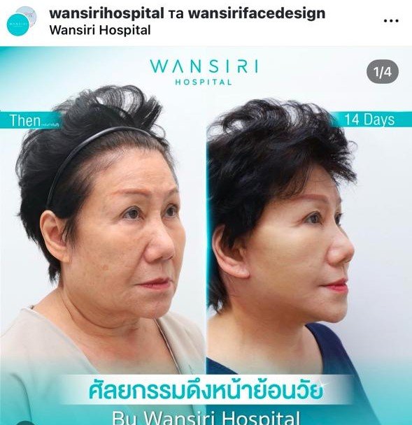 Before and after result by Dr. Jiraroch Meevassana