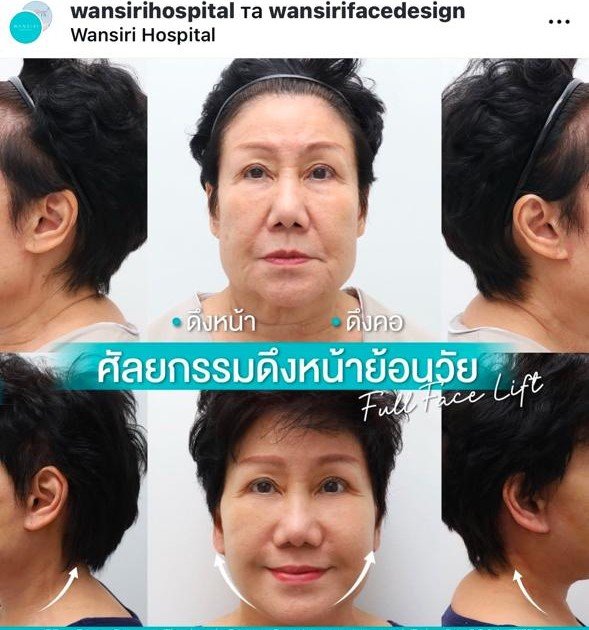 Before and after result by Dr. Jiraroch Meevassana