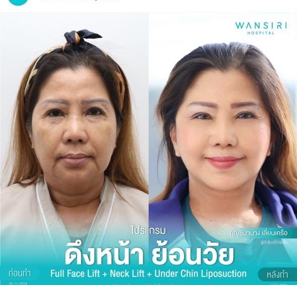 Before and after result by Dr. Jiraroch Meevassana