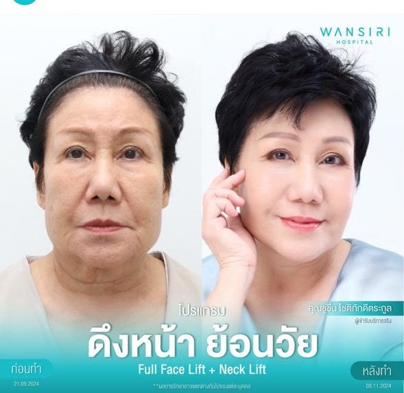 Before and after result by Dr. Jiraroch Meevassana