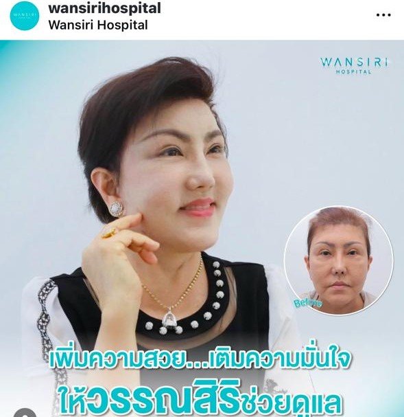 Before and after result by Dr. Jiraroch Meevassana