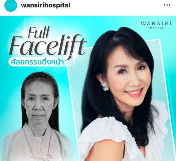 Before and after result by Dr. Jiraroch Meevassana