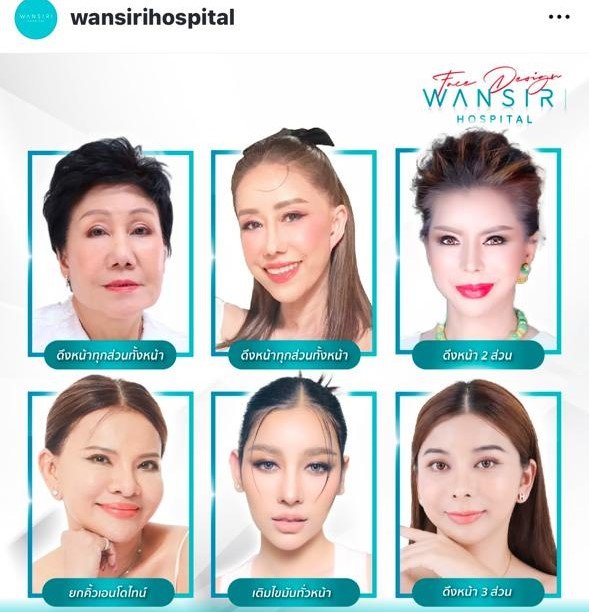 Before and after result by Dr. Jiraroch Meevassana