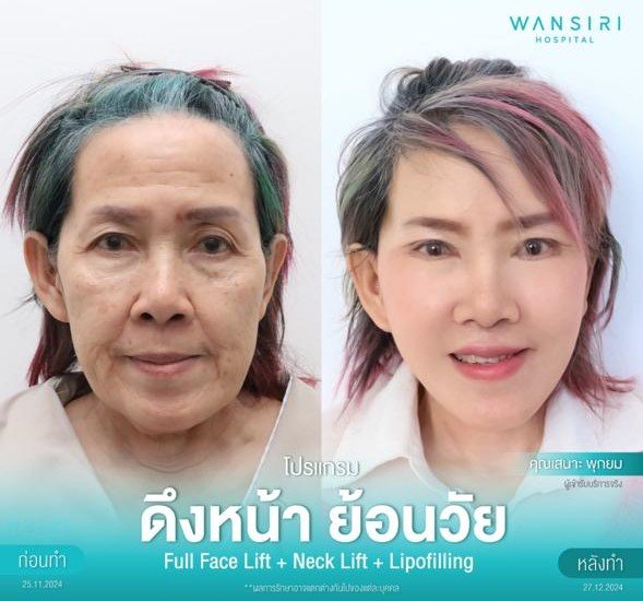 Before and after result by Dr. Jiraroch Meevassana