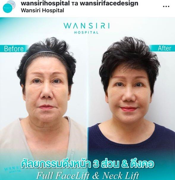 Before and after result by Dr. Jiraroch Meevassana