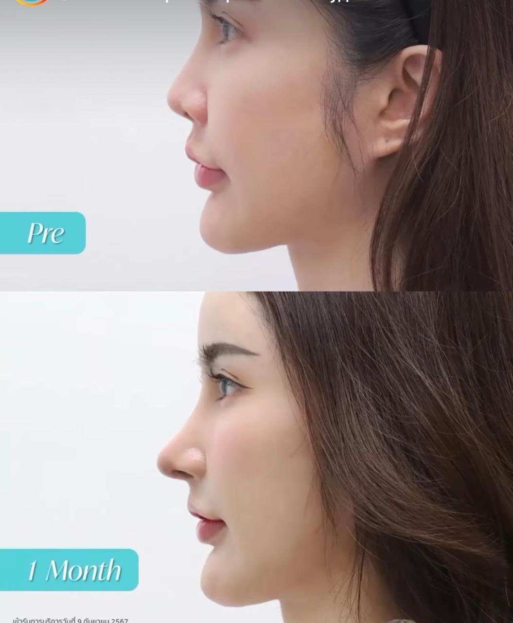 Before and after result by Dr. Jiraroch Meevassana